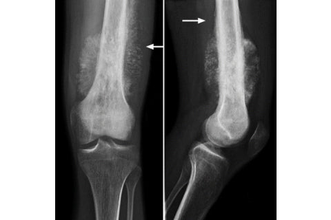 Genetic similarities of osteosarcoma between dogs and children.